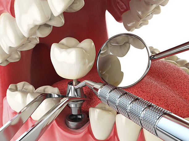 Best Emergency Dental Care for Broken or Chipped Teeth in Brandon, FL